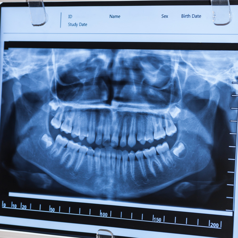 Crossville Family Dentistry - Digital X-Rays in Crossville Tennessee